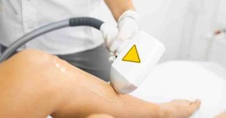 Combien de séances de laser faut-il pour une épilation définitive ?