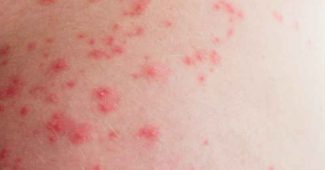 Tache rouge peau sans démangeaison : symptômes, causes et traitement
