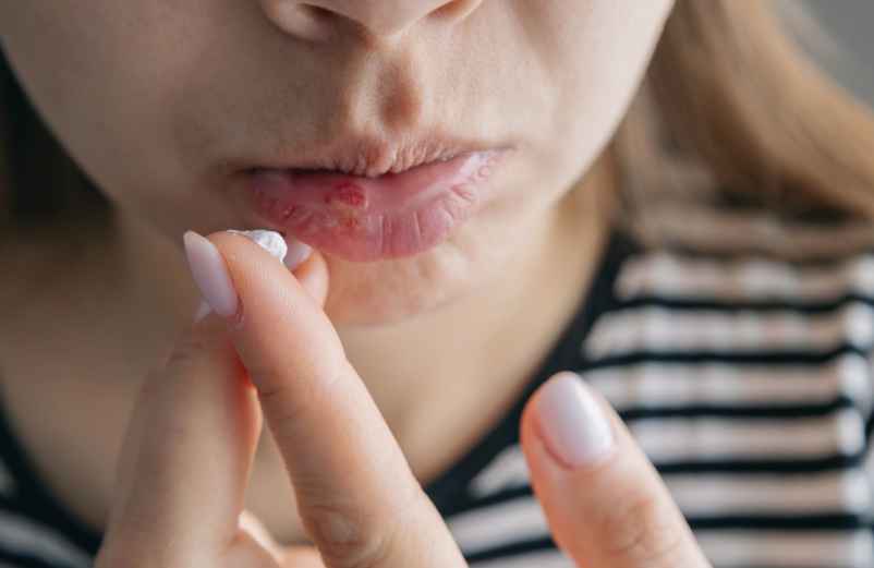 Peut-on vraiment enlever un bouton de fièvre en 5 minutes ?-FCMRR