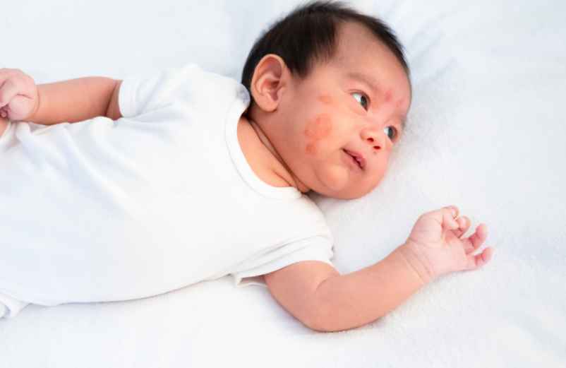Pourquoi l’eczéma apparaît-il chez le bébé ?-FCMRR