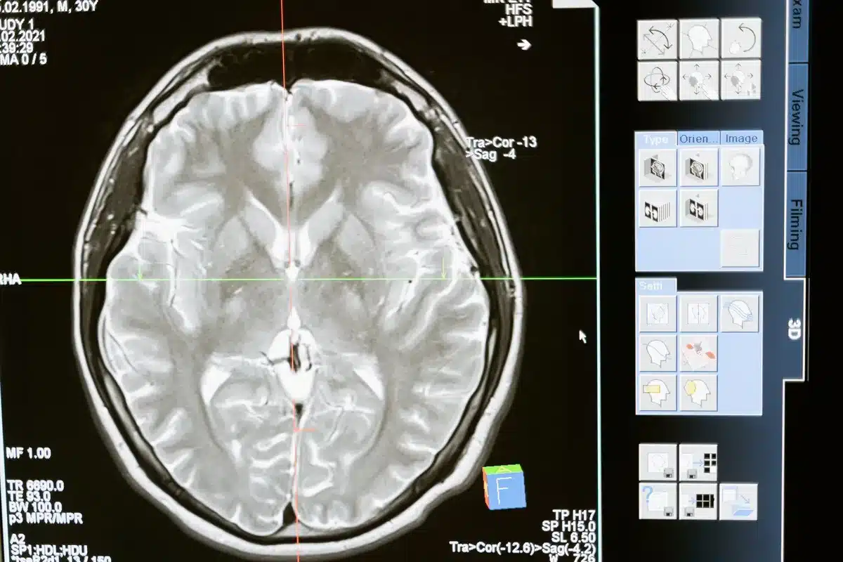 Image d'IRM cérébrale montrant les régions du cerveau analysées lors de l'étude