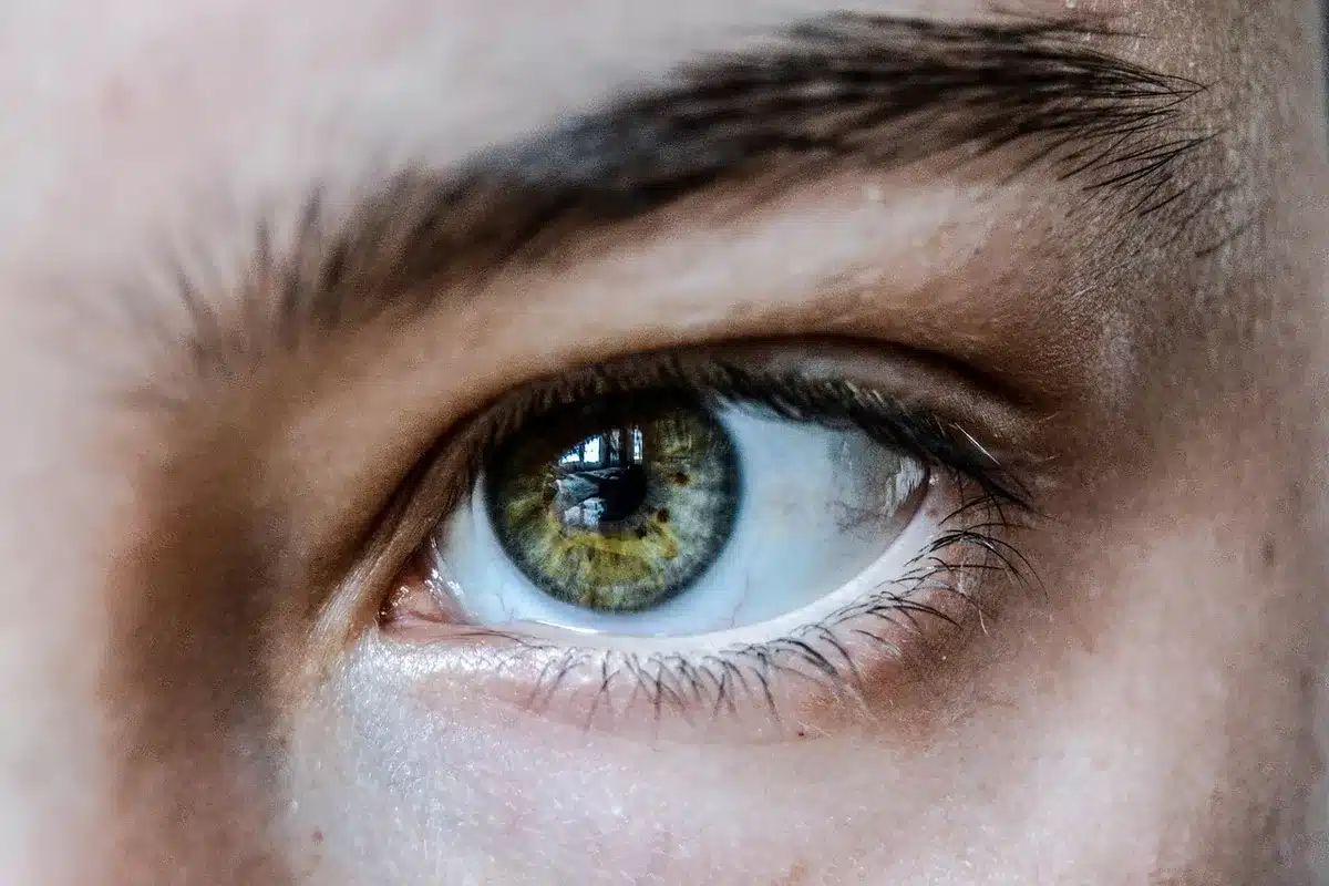 Visage et mains avec coloration jaune caractéristique de la jaunisse